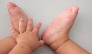 手足口病初期症状图 手足口病初期有什么症状